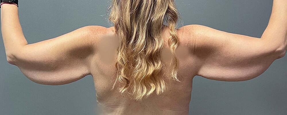 Arm Lift Before & After