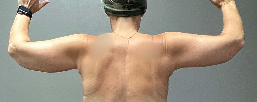 Arm Lift Before & After