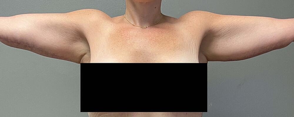 Arm Lift Before & After