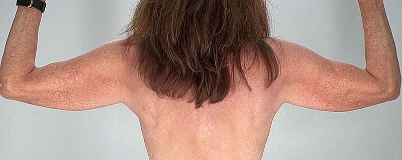 Arm Lift Before & After