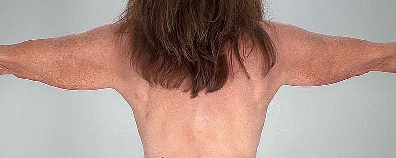 Arm Lift Before & After