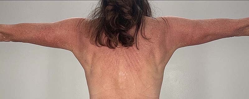 Arm Lift Before & After