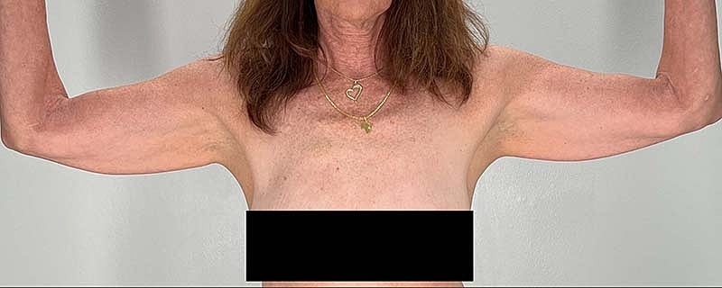 Arm Lift Before & After