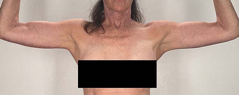 Arm Lift Before & After