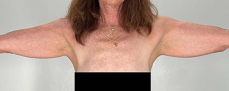 Arm Lift Before & After