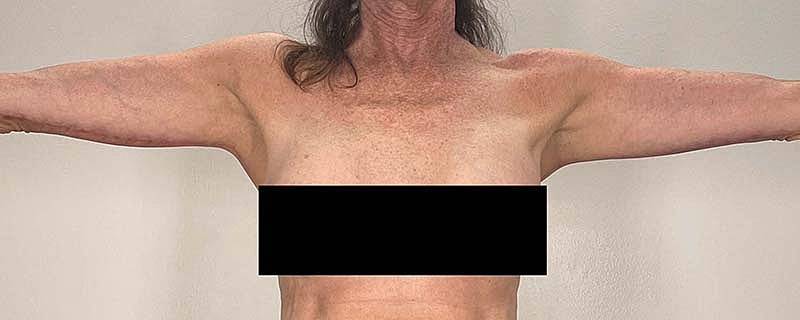 Arm Lift Before & After
