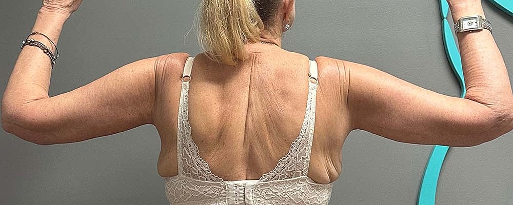 Arm Lift Before & After