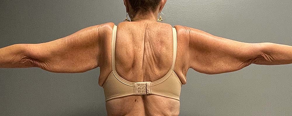 Arm Lift Before & After
