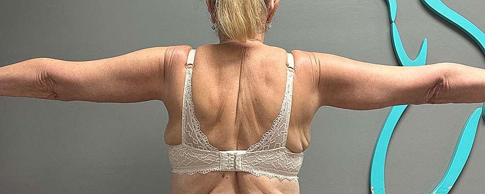 Arm Lift Before & After
