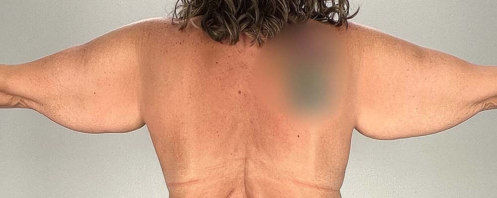 Arm Lift Before & After