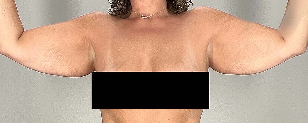 Arm Lift Before & After