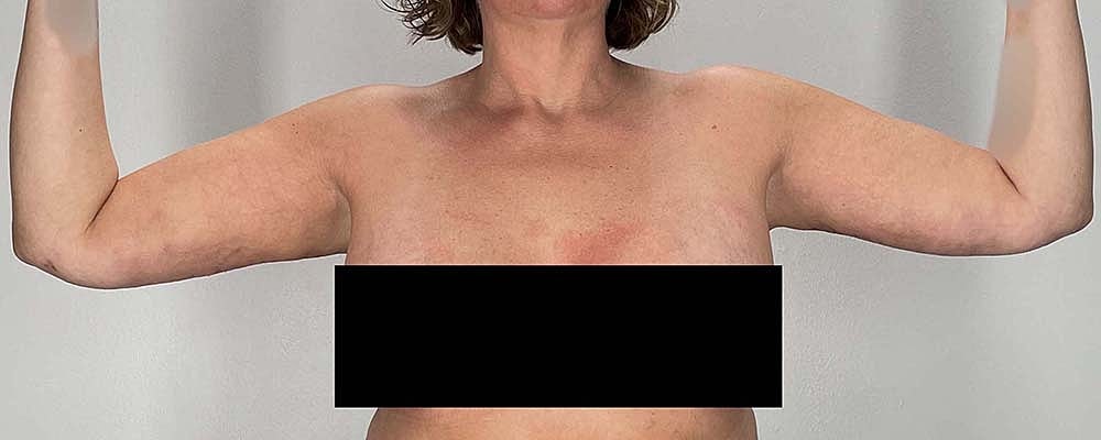 Arm Lift Before & After