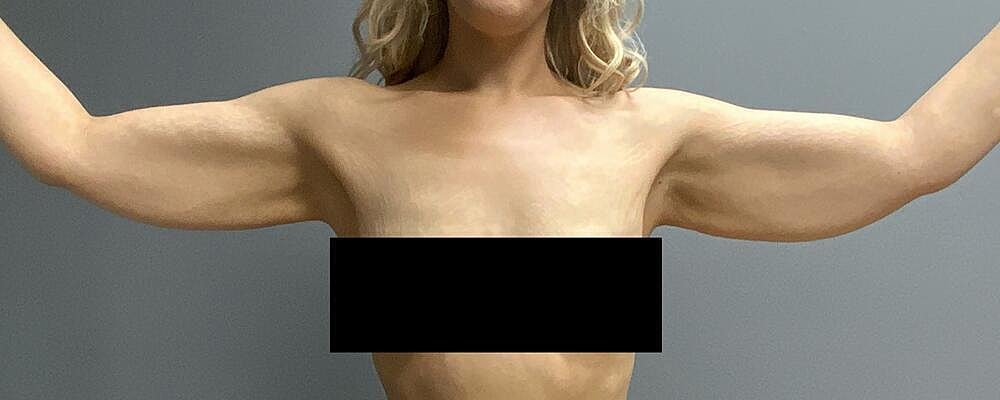 Arm Lift Before & After