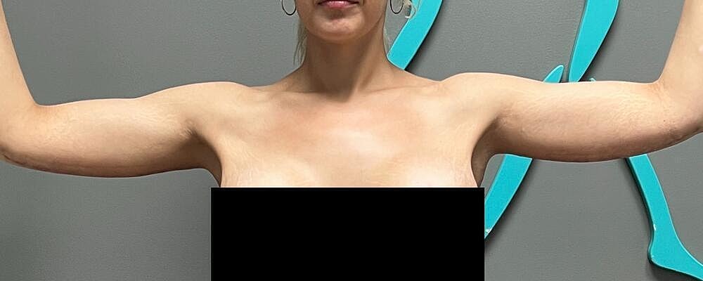 Arm Lift Before & After
