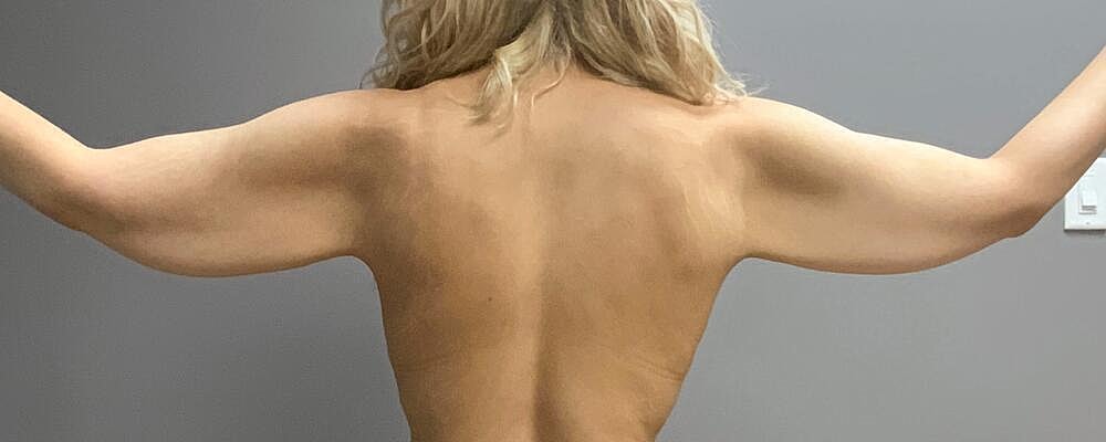 Arm Lift Before & After