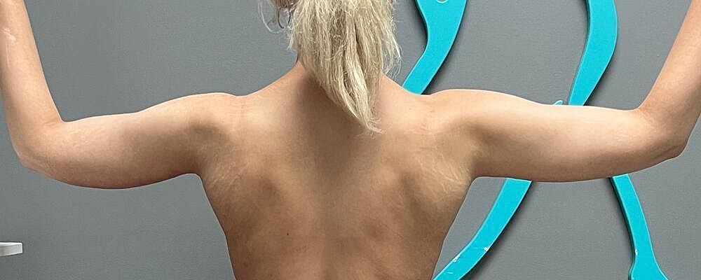 Arm Lift Before & After