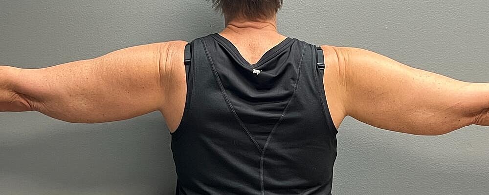 Arm Lift Before & After