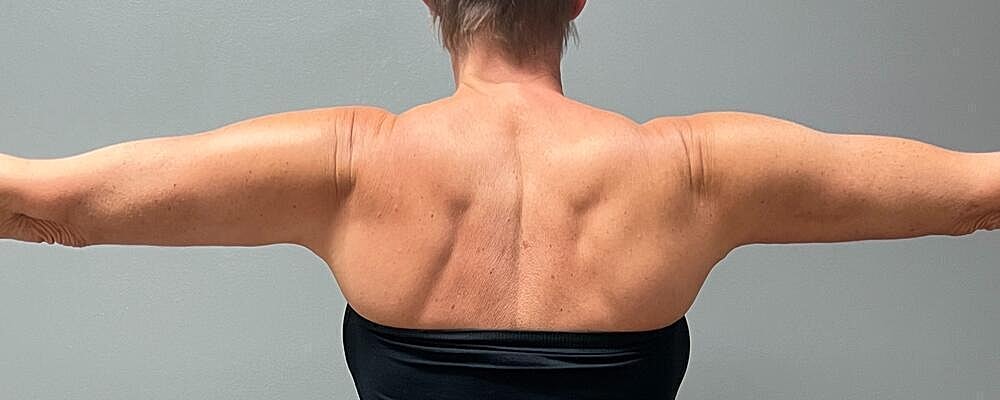 Arm Lift Before & After