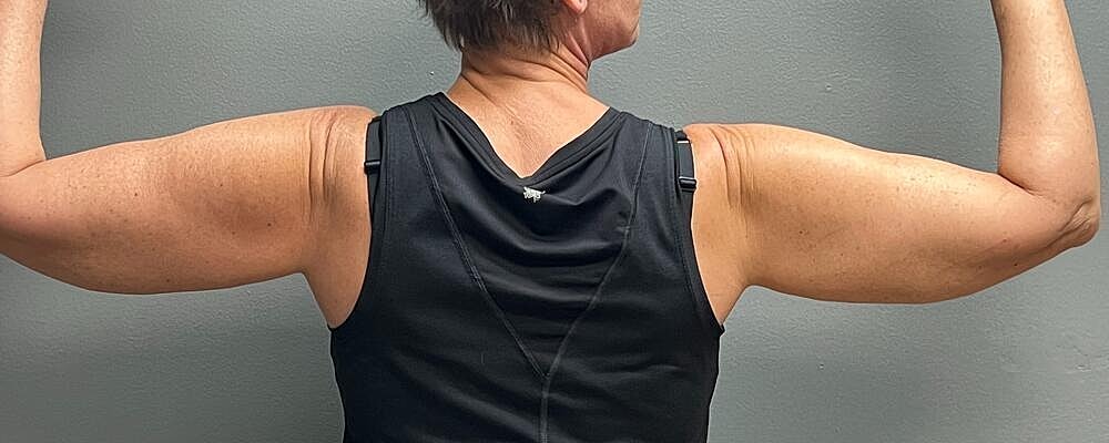 Arm Lift Before & After
