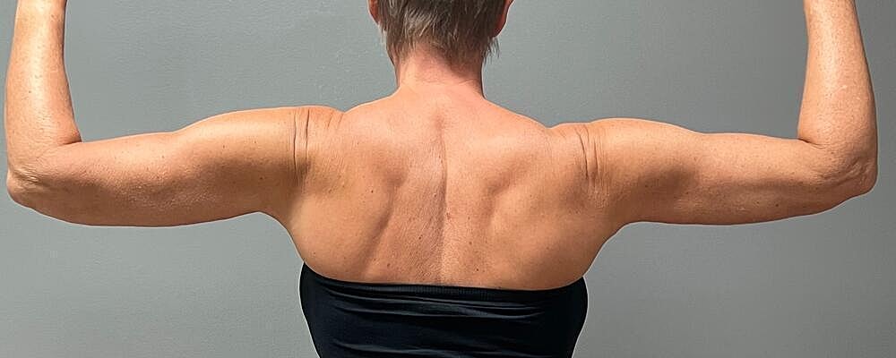 Arm Lift Before & After