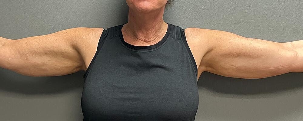 Arm Lift Before & After