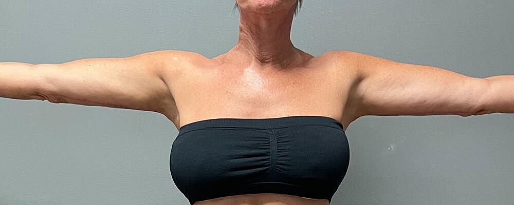 Arm Lift Before & After