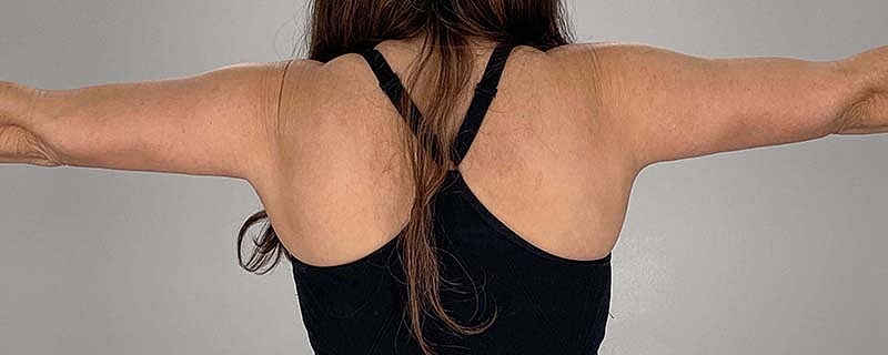 Arm Lift Before & After