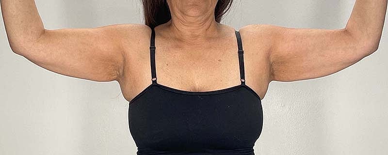Arm Lift Before & After