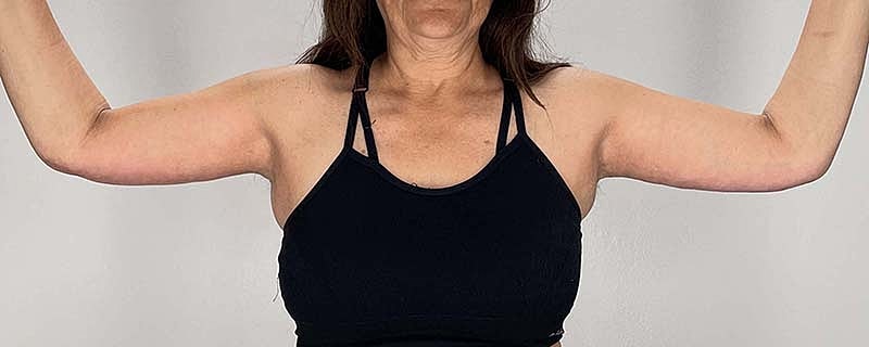 Arm Lift Before & After