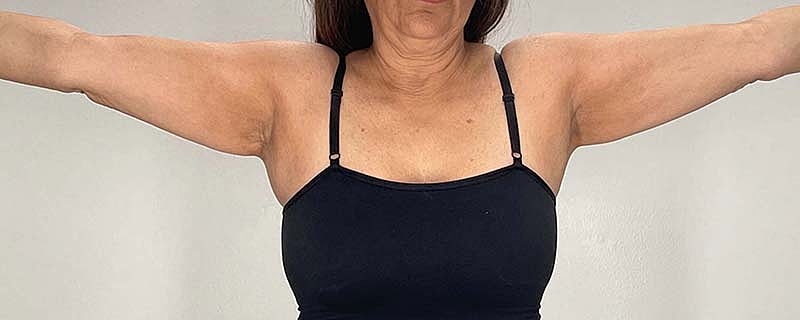 Arm Lift Before & After