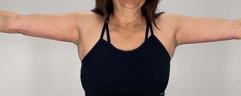 Arm Lift Before & After