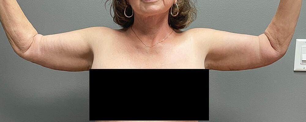 Arm Lift Before & After