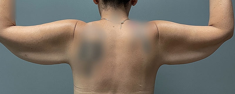 Arm Lift Before & After