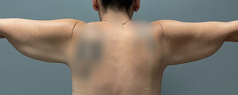 Arm Lift Before & After