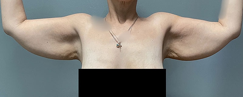Arm Lift Before & After