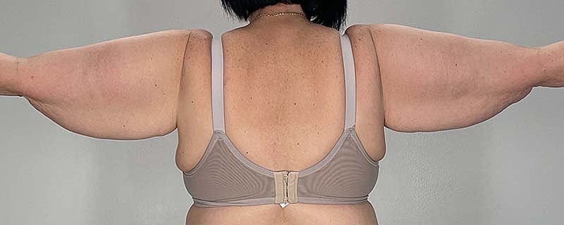 Arm Lift Before & After