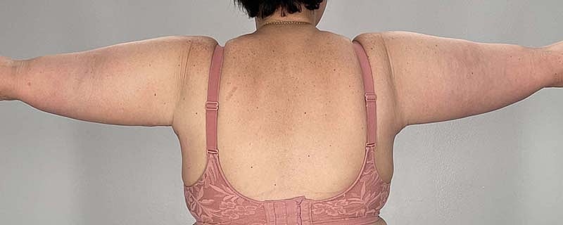 Arm Lift Before & After