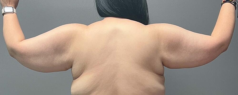 Arm Lift Before & After
