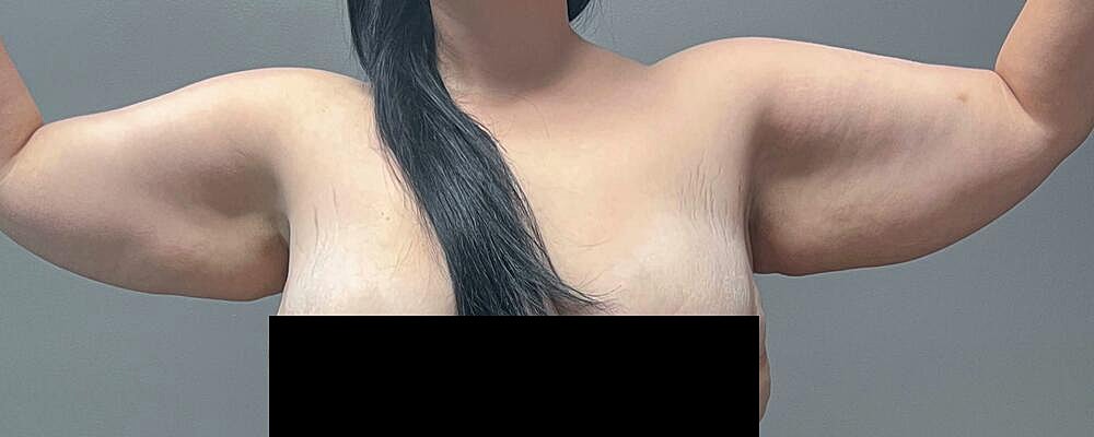 Arm Lift Before & After