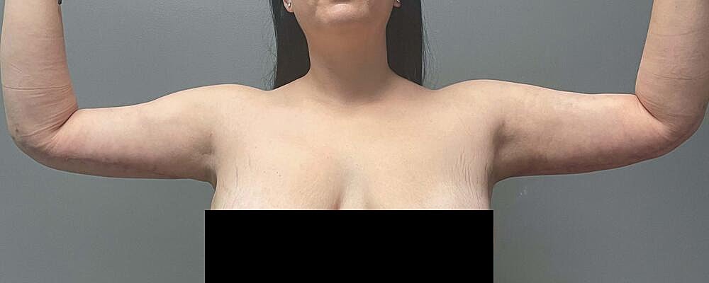 Arm Lift Before & After