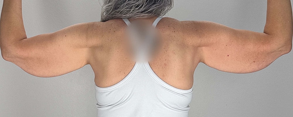 Arm Lift Before & After