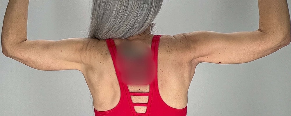 Arm Lift Before & After