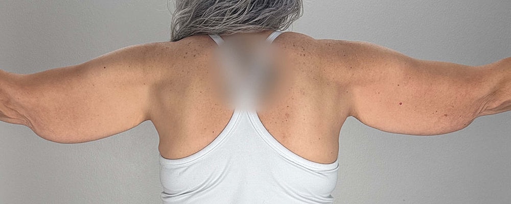 Arm Lift Before & After