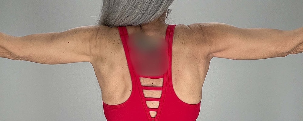 Arm Lift Before & After