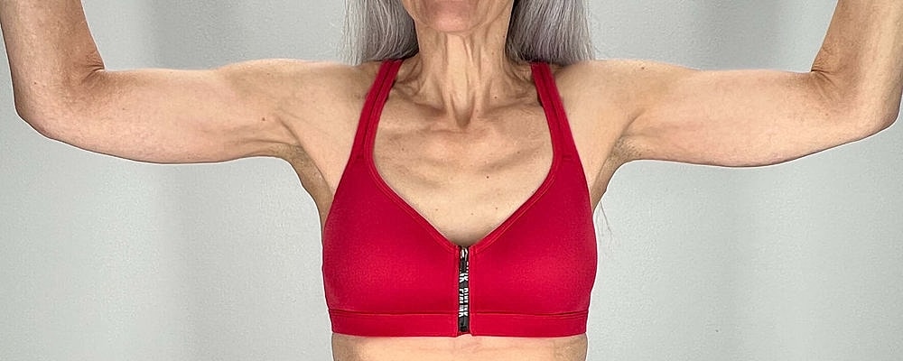 Arm Lift Before & After