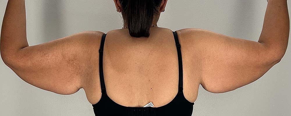 Arm Lift Before & After