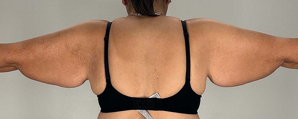 Arm Lift Before & After