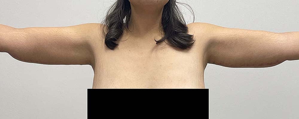 Arm Lift Before & After