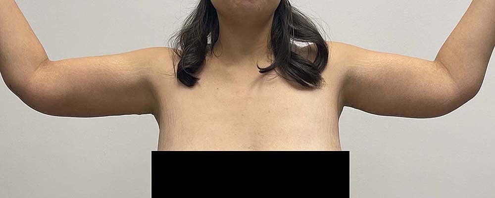 Arm Lift Before & After