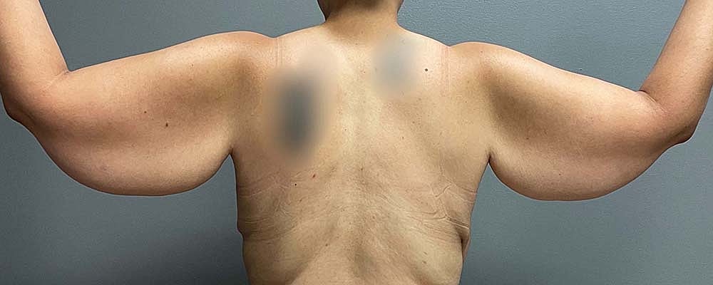 Arm Lift Before & After